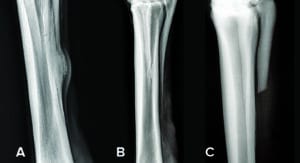 Fig.2: A) Splint bone exostosis; B) Distal splint bone fracture; C) Amputated splint bone (Images courtesy APIAM).