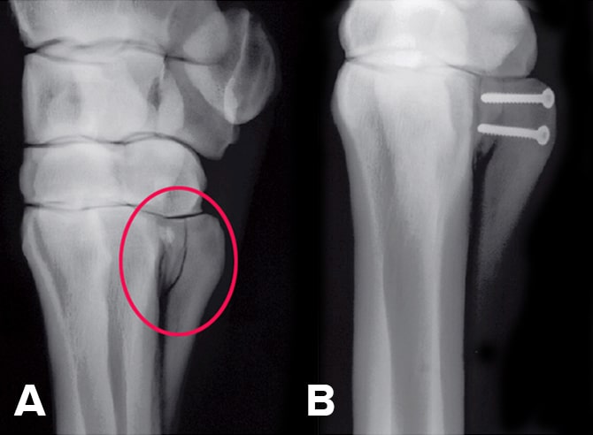 Fig.3: A) Proximal splint fracture; B) Fracture fragments stabilised (Images courtesy APIAM).