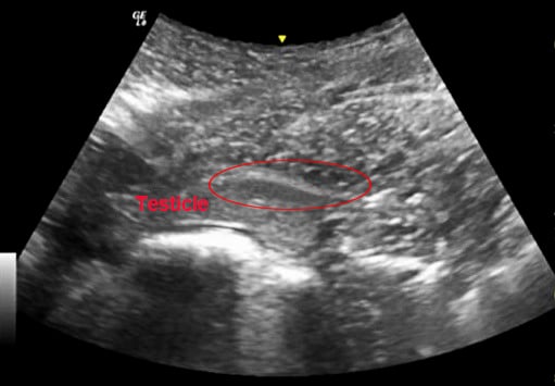 Ultrasound of an undescended testicle (Image courtesy APIAM).